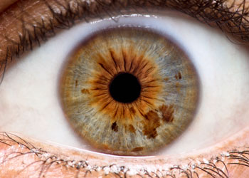 Iridology Iris #9 from Iridology Exam & Analysis Iridology analysis of Iris #9 from iridology exam.