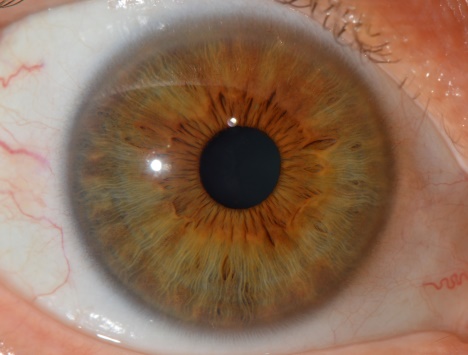 iris #2 photograph for iridology analysis